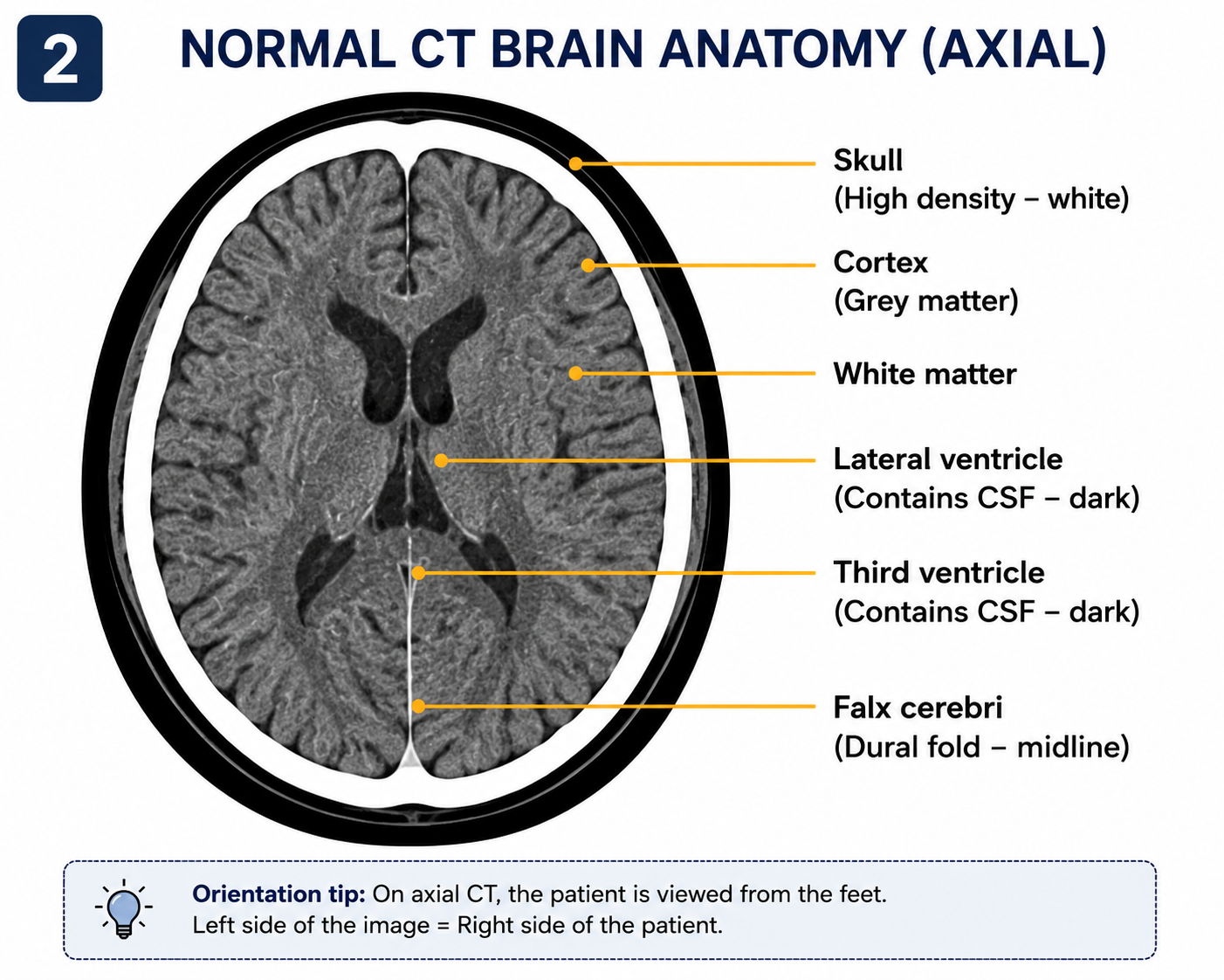 Normal CT brain anatomy with labelled structures
